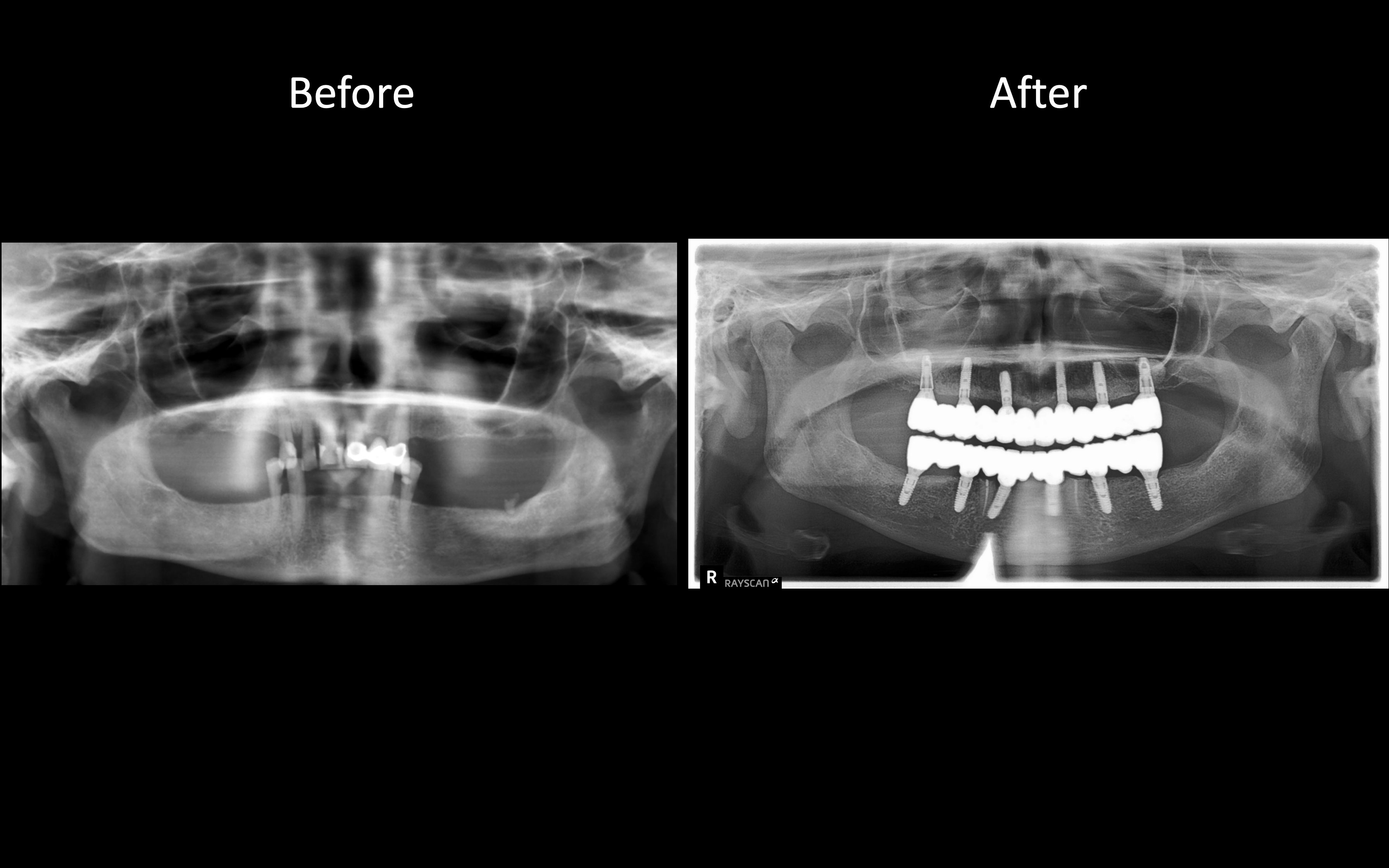 Full Mouth Implant Reconstruction X-Ray Case 1